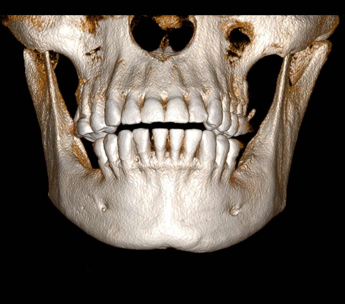 Tomografia de feixe cônico (CBCT) para planejamento ortodôntico