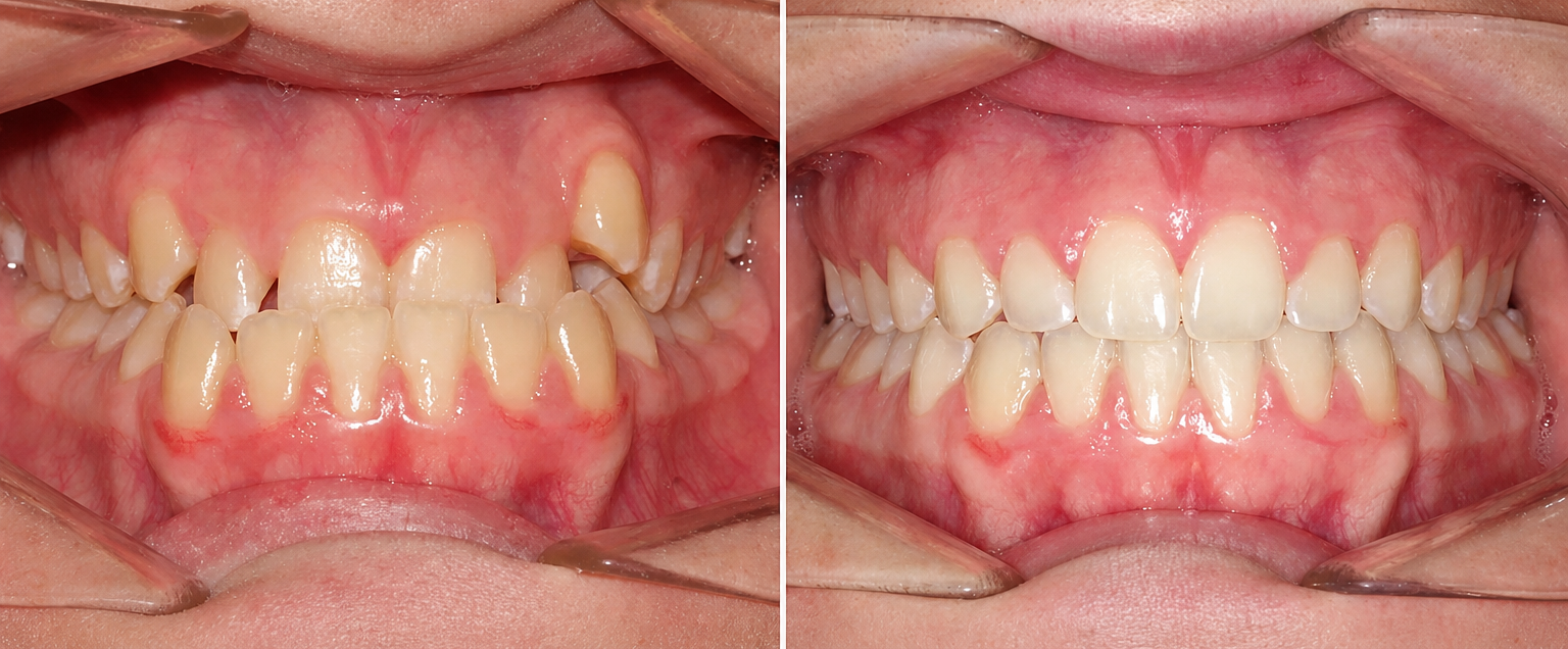 Antes e depois da correção da mordida invertida com o Método PhD